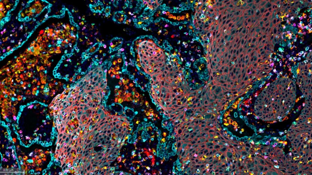Abstract representation of a lung with cells responding to treatment