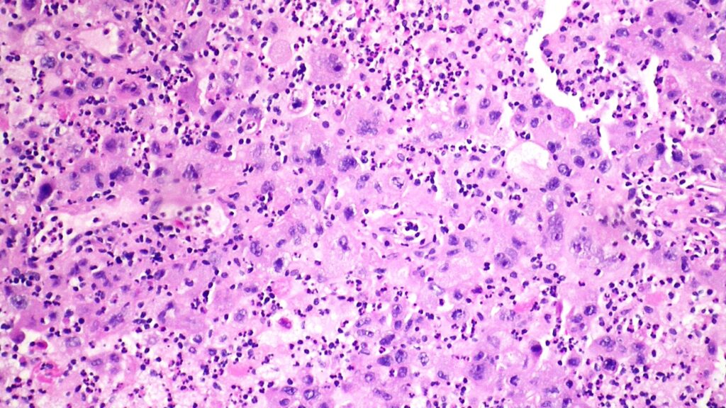An executive leading a biotech team towards innovative cancer solutions