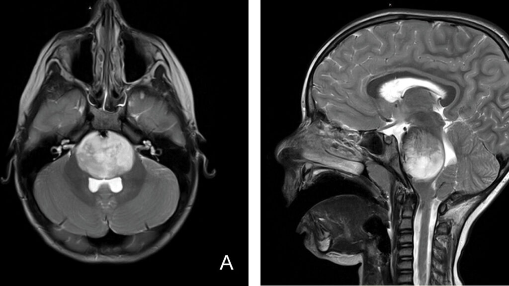 Abstract representation of CAR-T cells targeting brain tumor cells