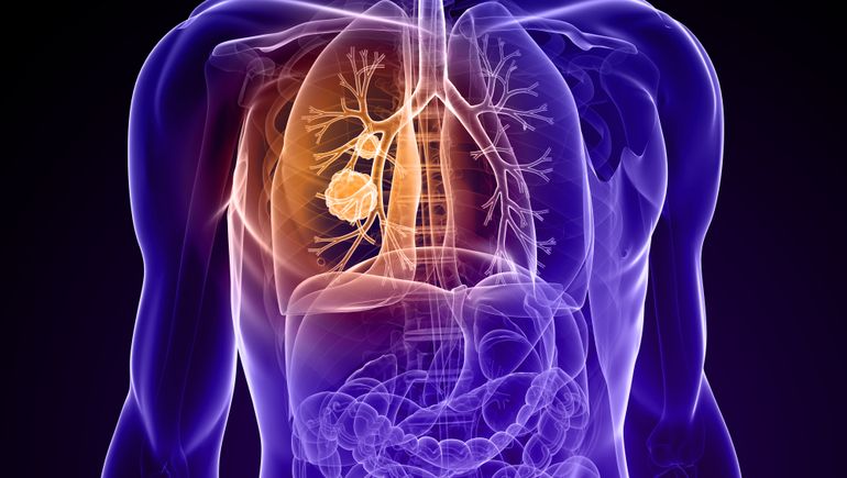 A new oral medication designed to halt cancer cell proliferation in a specific genetic alteration known as ROS1